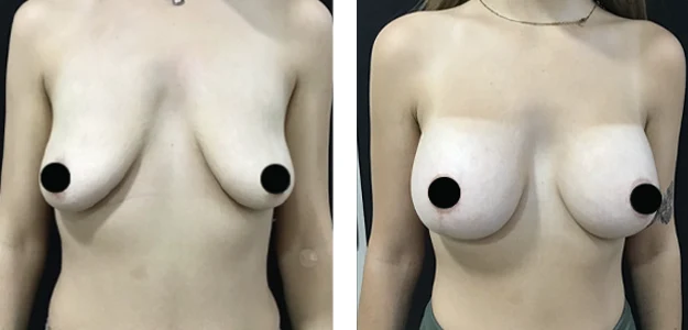 pecho-antes-despues